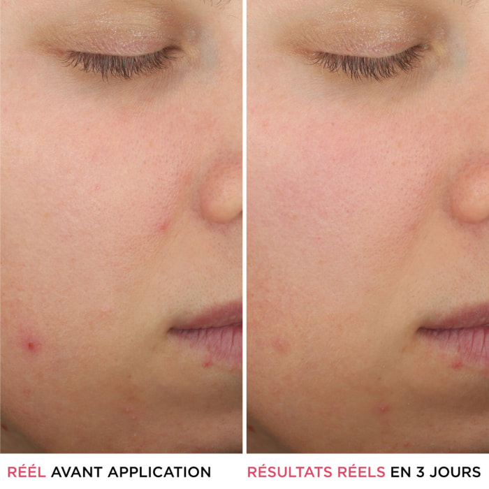 Bye Bye Breakout - Sérum Anti-Acné à l'Acide Salicylique 30 ml