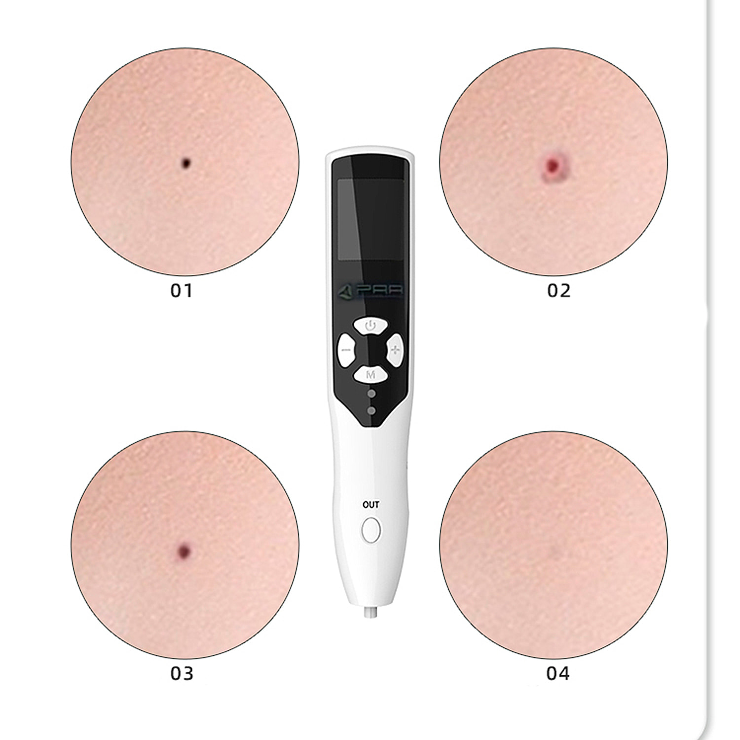 Bolígrafo multifuncional de ozono con 5 cabezales.