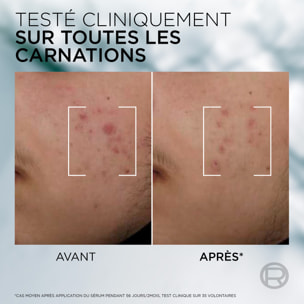 L'Oréal Paris Men Expert Derma Control Sérum Anti-Imperfections Niacinamide 30ML