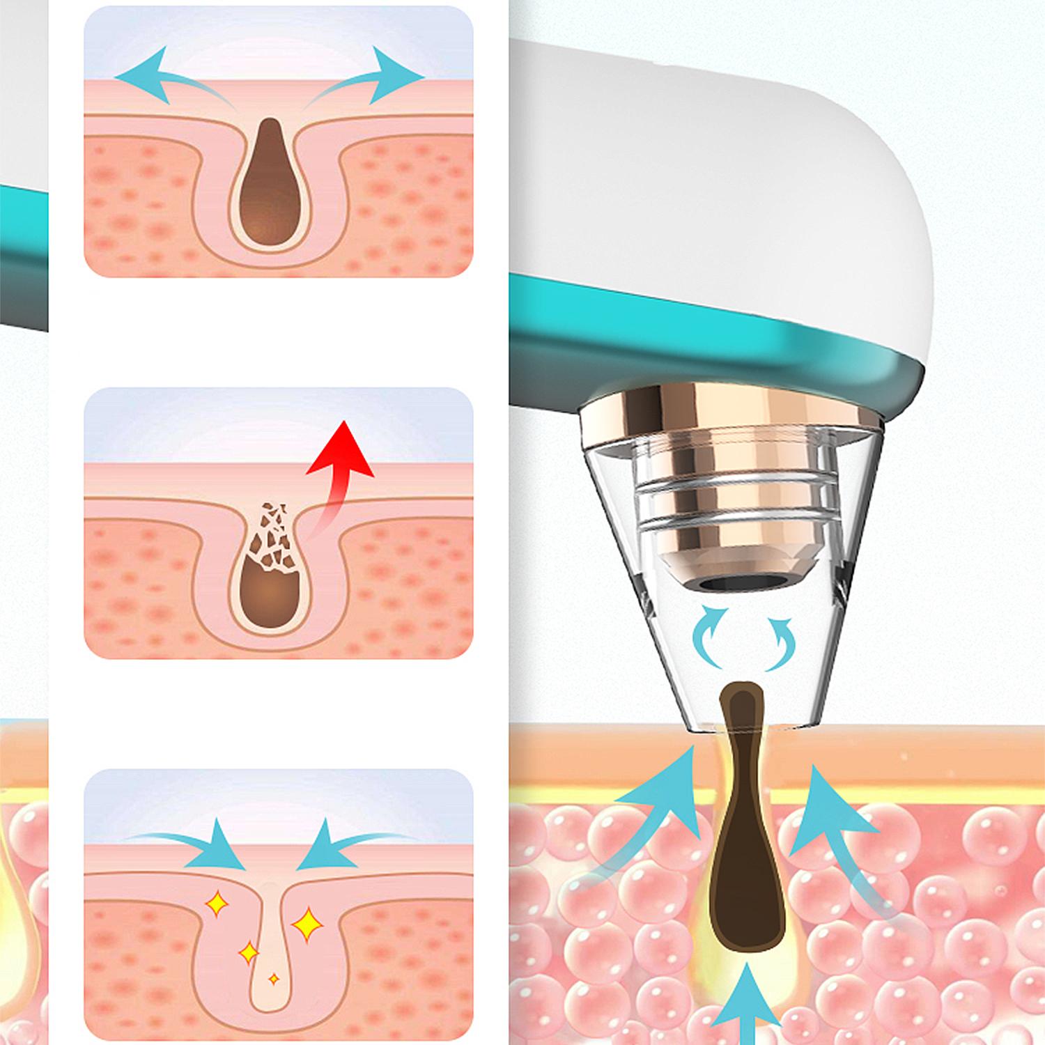 X9 Estrattore di punti neri con fototerapia ringiovanente, ultrasuoni e carica ionica.