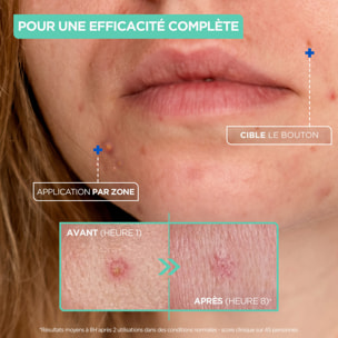 Mixa Pâte Concentrée Anti-Bouton, Pâte Anti-Boutons Ciblée à l'Acide Salicylique et à la Niacinamide- Action rapide sur tous les