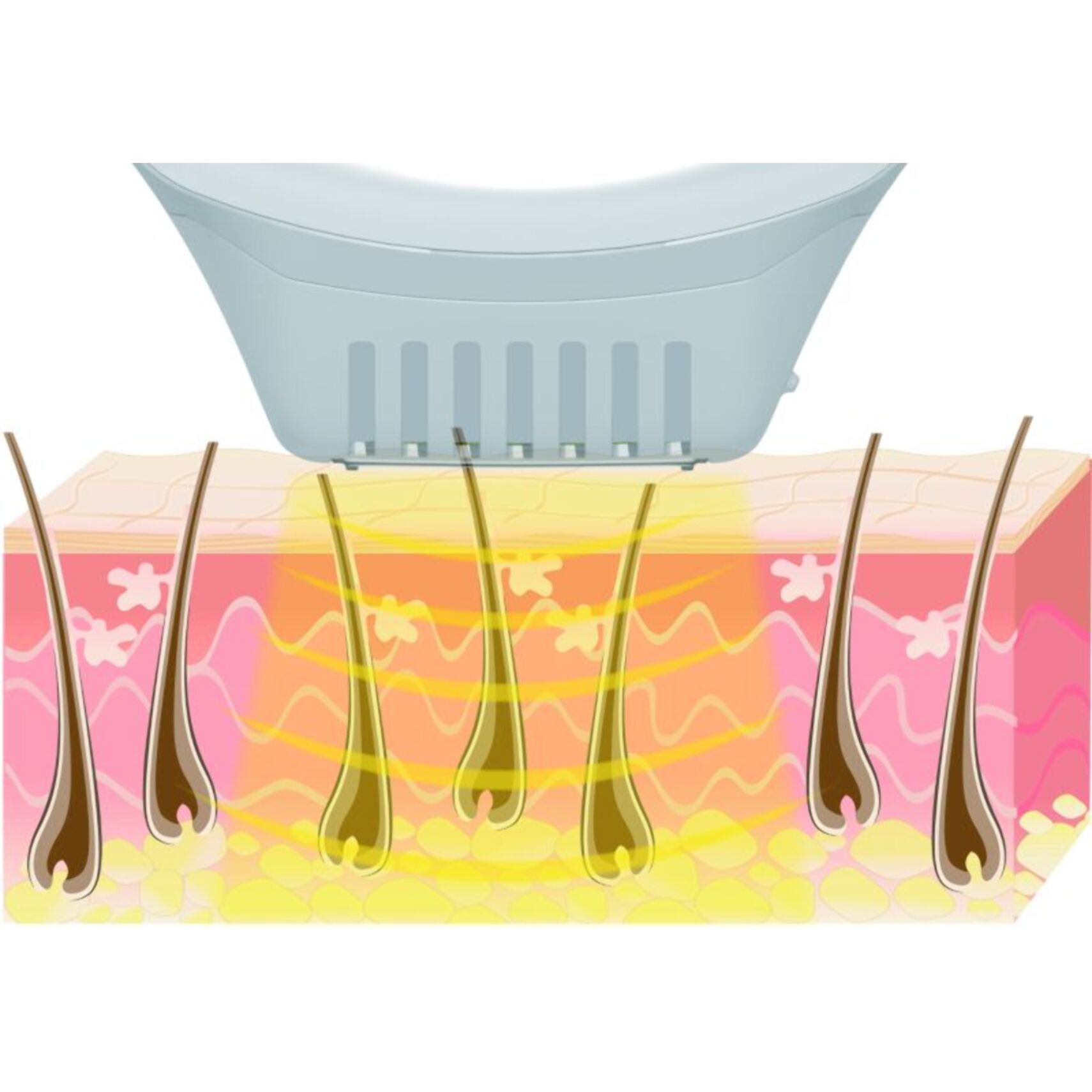 Epilateur lumière pulsée BEURER 10000 +