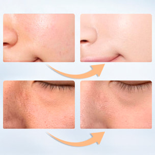 Lámpara portátil de luminoterapia con 5 tipos de luces: roja, verde, azul, naranja y morada.