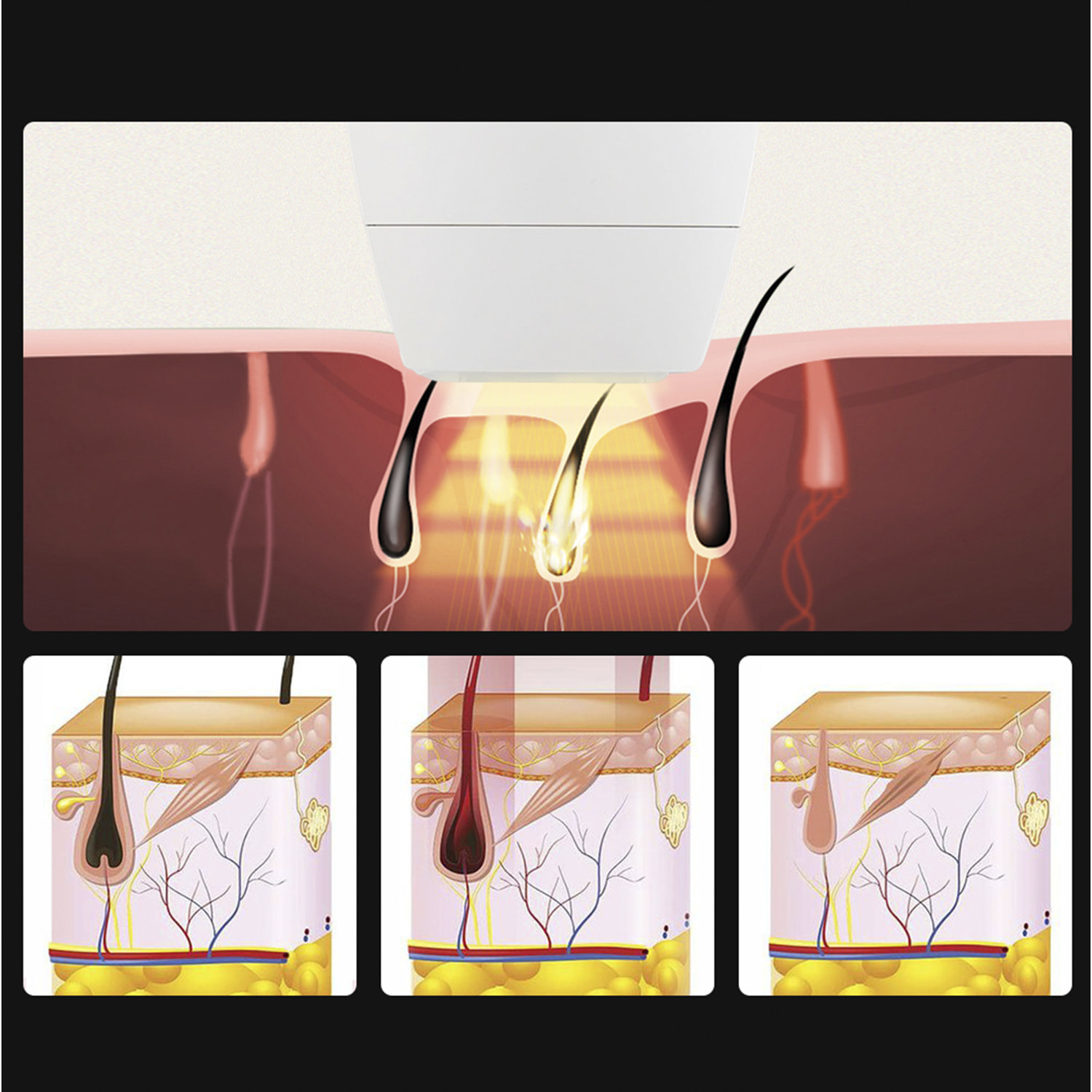 Strumento per la depilazione con luce colorata. Tubo lampada al quarzo.