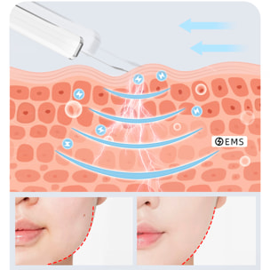 Instrumento de belleza para eliminar puntos negros.