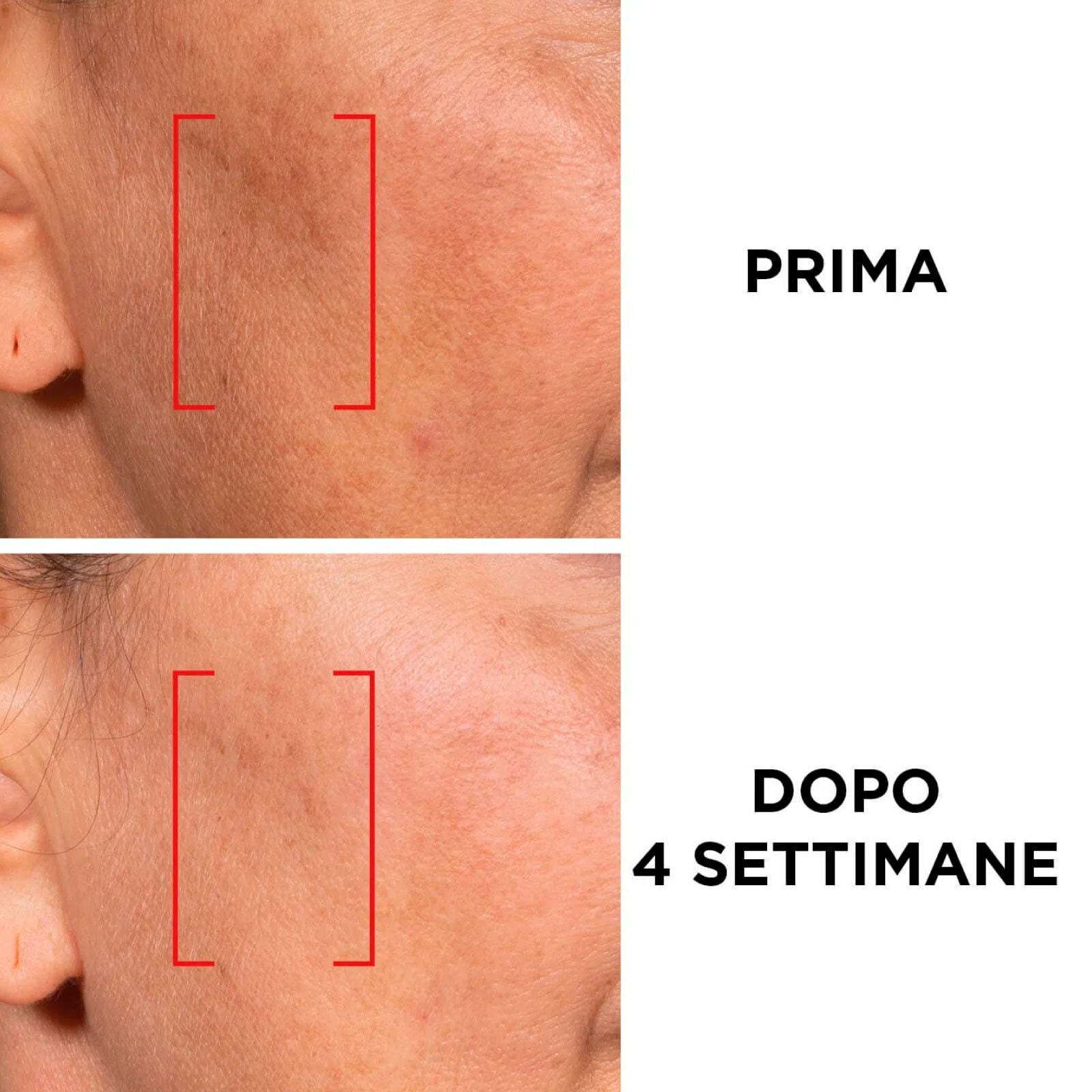 Crema Giorno SPF 25 Anti-Età per Viso Revitalift Laser Trattamento Profondo Ridensificante Anti-Macchie con Acido Ialuronico e Pro-Xylane