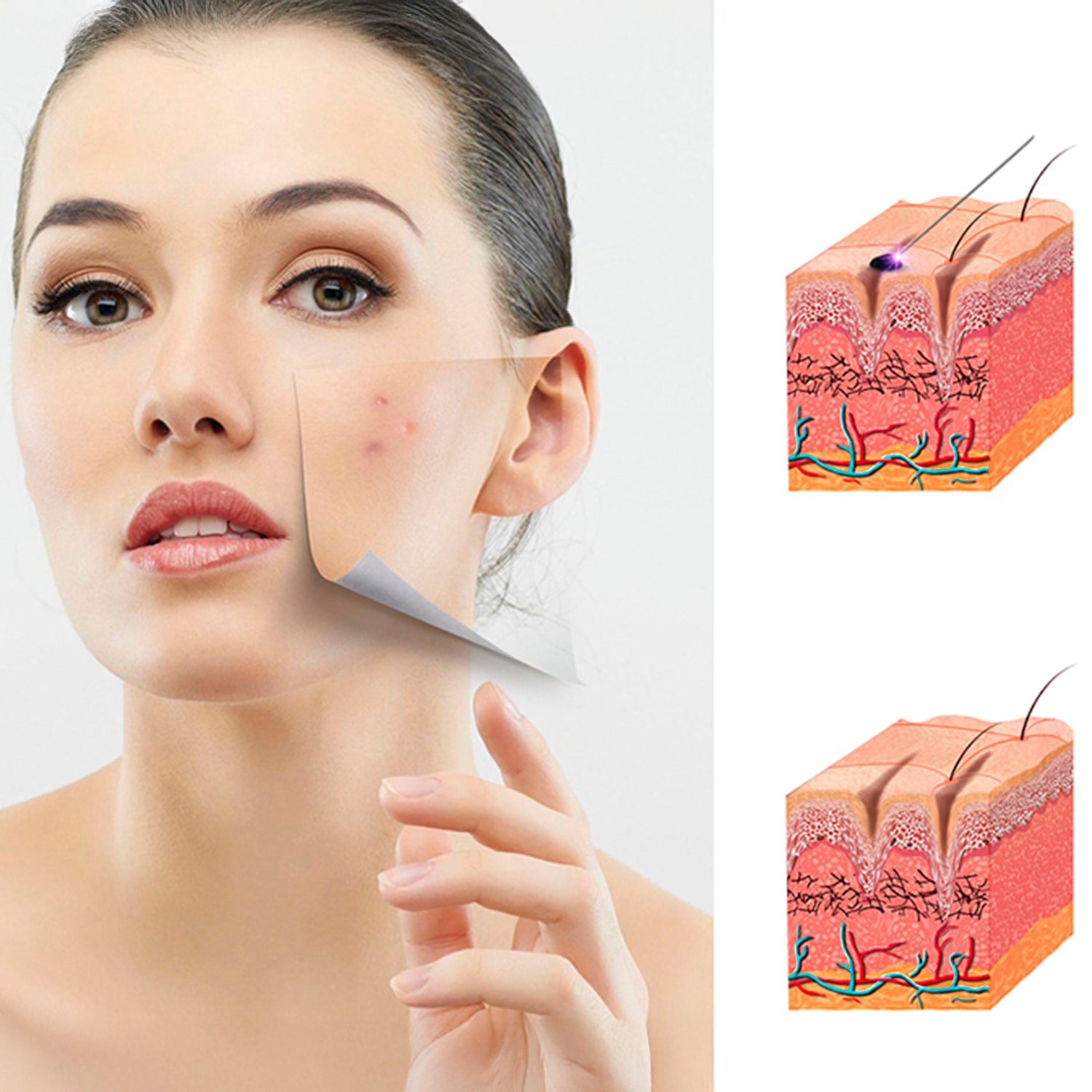 Bolígrafo eléctrico para eliminar imperfecciones de la piel, lunares, manchas, verrugas, pecas, etc. Incluye 3 agujas finas y 1 gruesa.