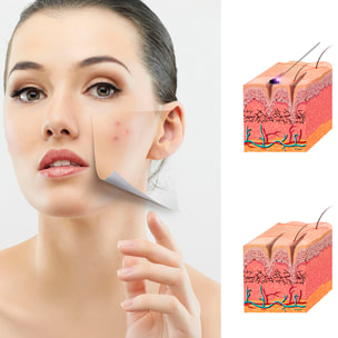 Bolígrafo eléctrico para eliminar imperfecciones de la piel, lunares, manchas, verrugas, pecas, etc. Incluye 3 agujas finas y 1 gruesa.