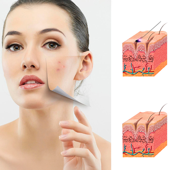 Penna elettrica per rimuovere imperfezioni della pelle, nei, macchie, verruche, lentiggini, ecc. Include 3 aghi sottili e 1 spesso.