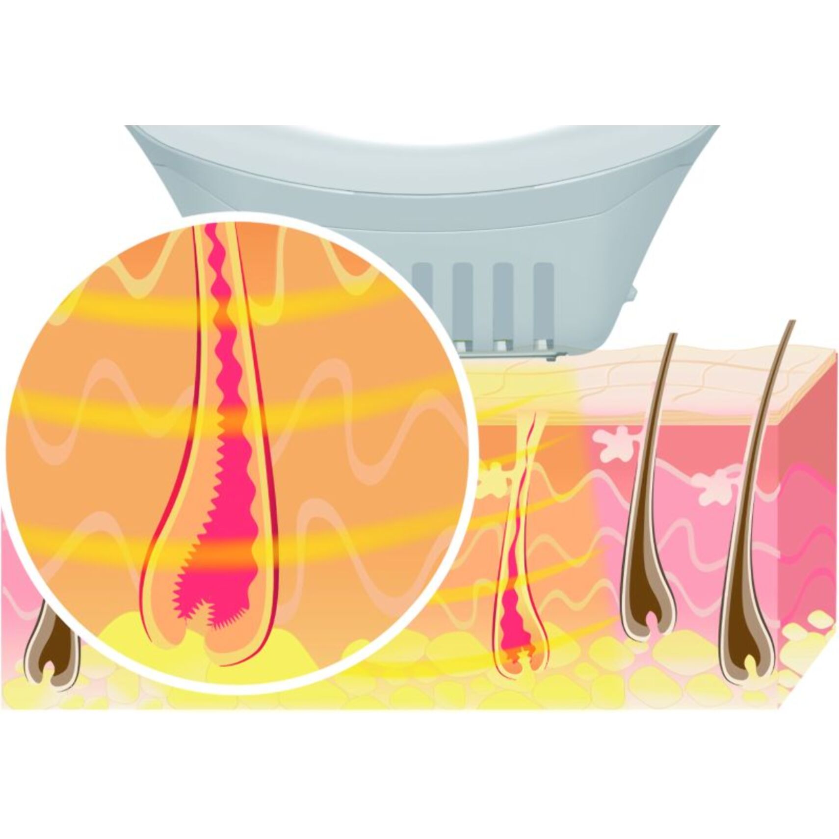 Epilateur lumière pulsée BEURER 10000 +