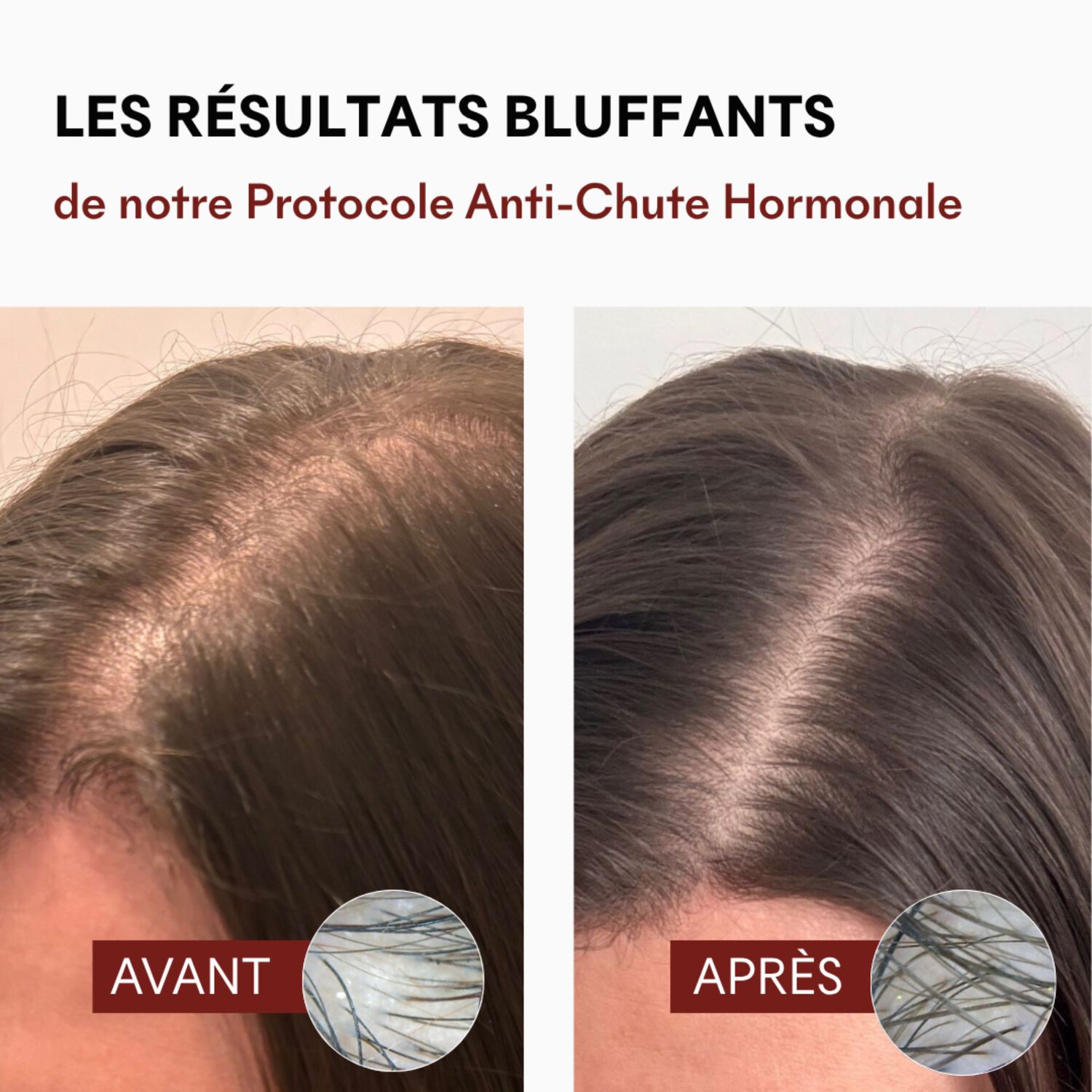 DHT Blocker - Complement Alimentaire Anti-Chute Hormonale 3 Mois