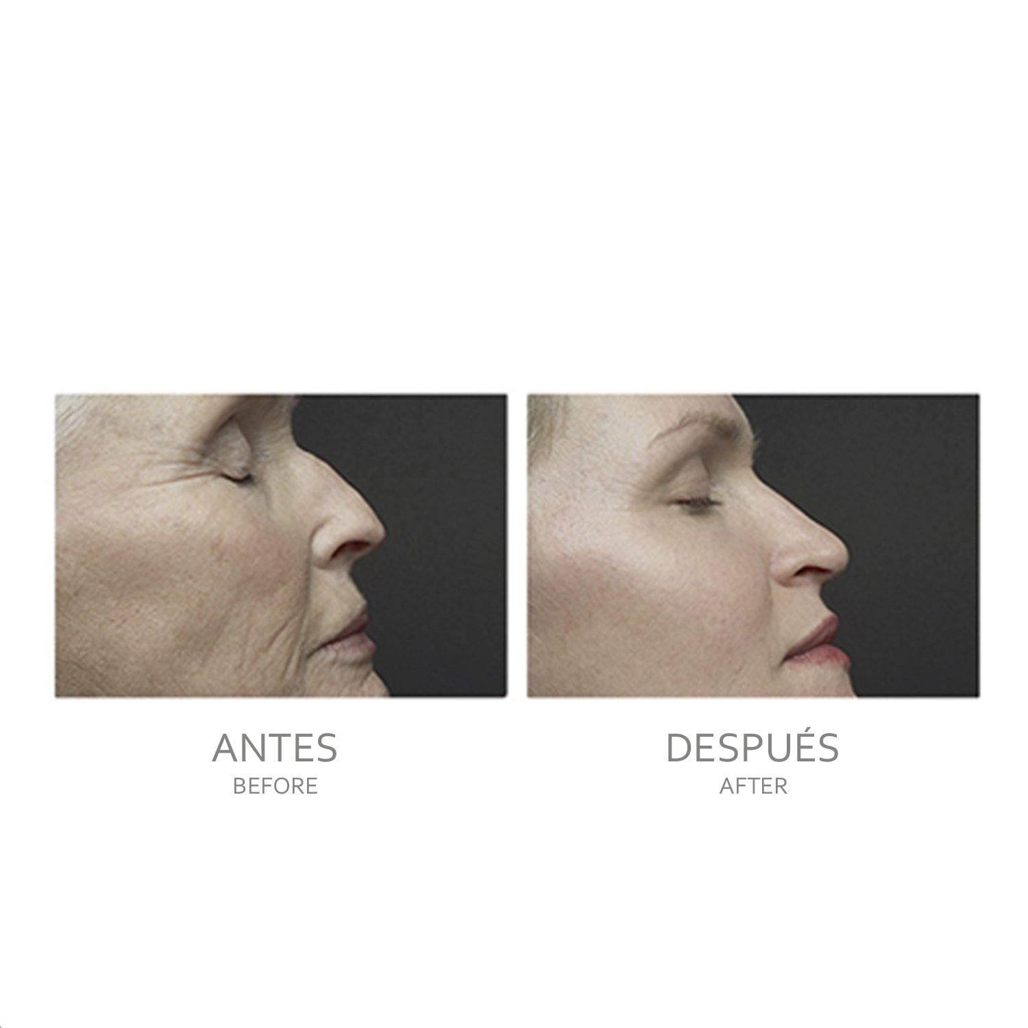 Instrumento de cuidado de la piel 4 en 1: EMS, radiofrecuencia, ultrasonidos, pulsos.