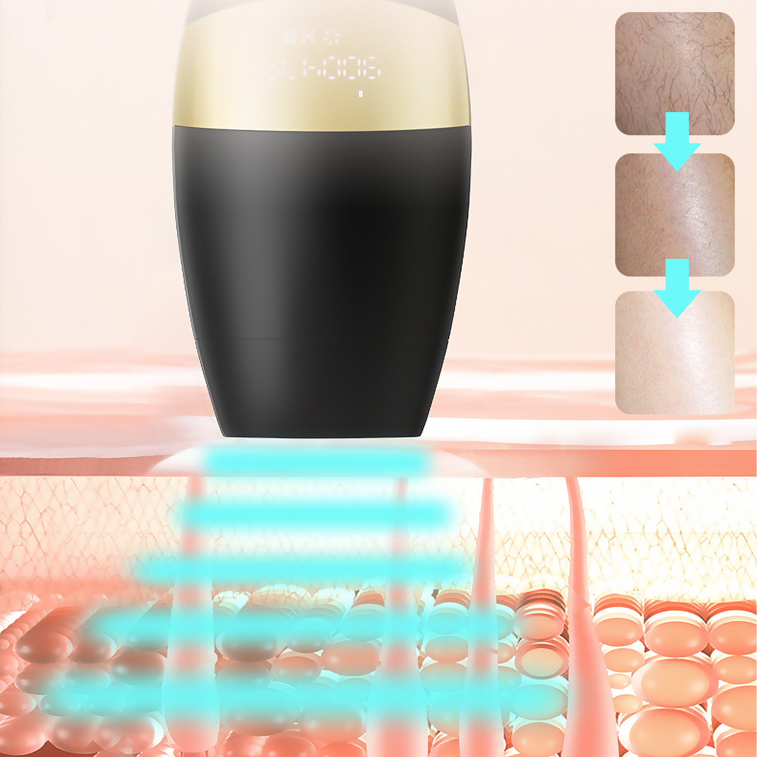 Instrumento de depilación con luz de color. Tubo de lámpara de cuarzo.