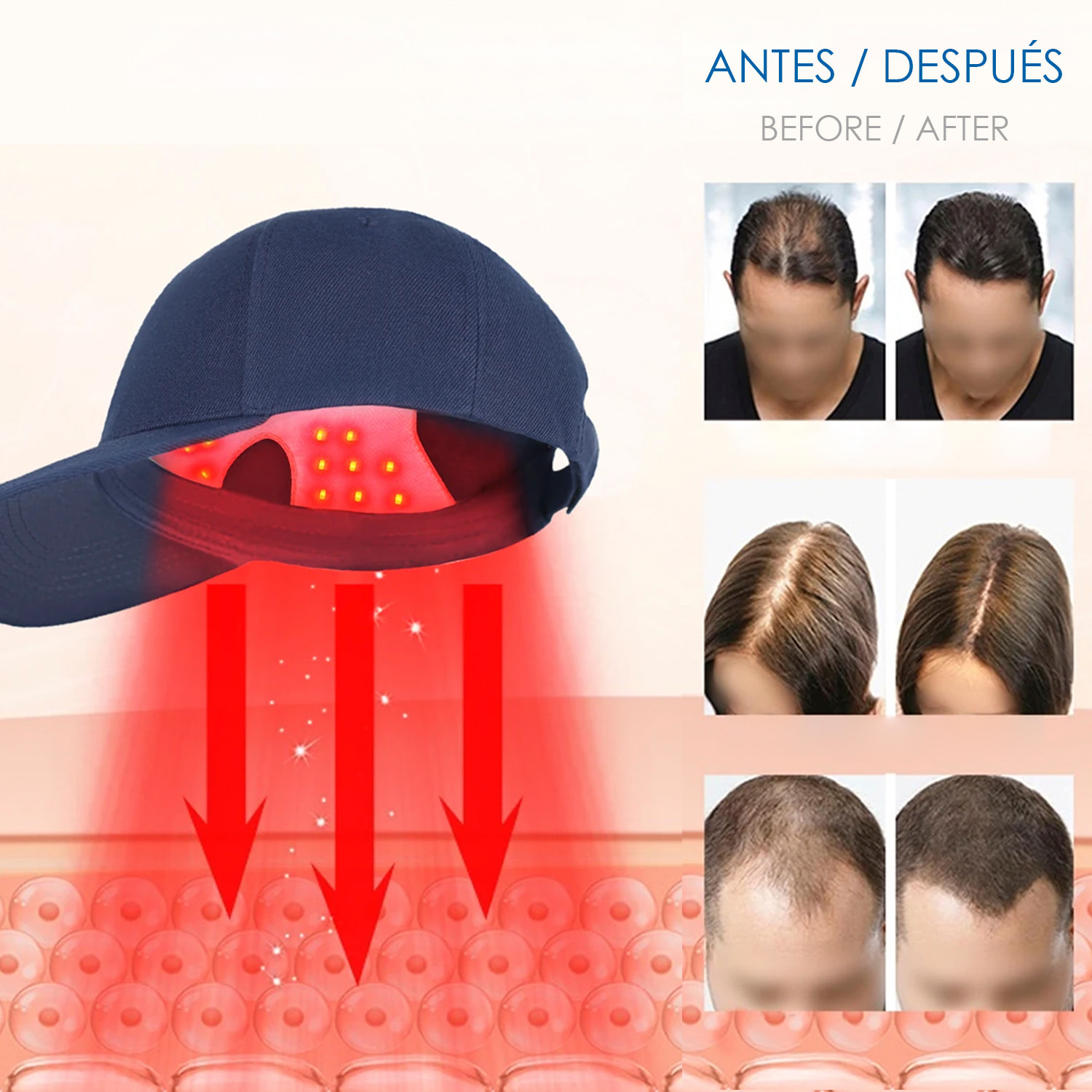 Gorra masajeadora con tratamiento capilar por luz LED. Mejora circulación, ayuda a fortalecer y anti-caída.