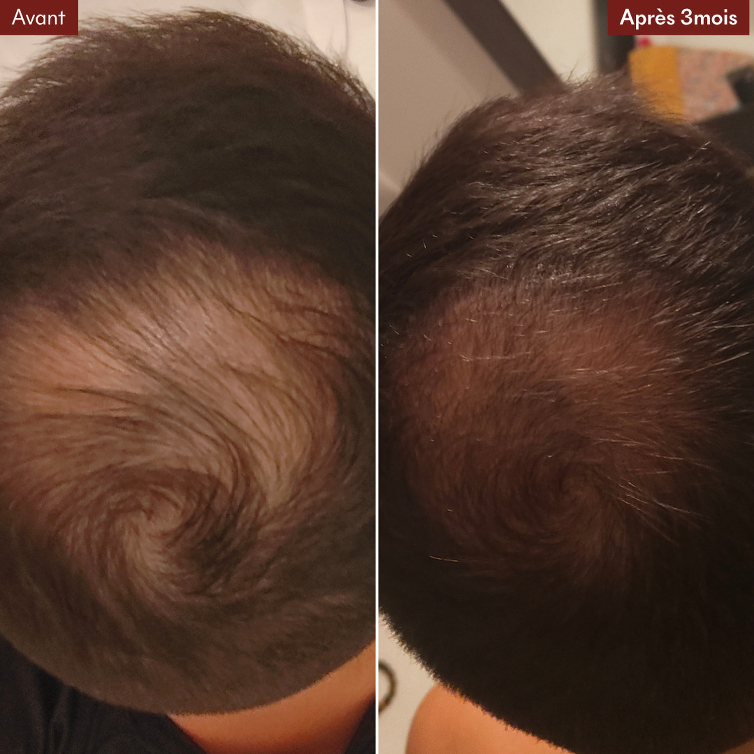 Tricho-Boost  - Cure Sérum Anti-Chute de Cheveux 3×20 ml