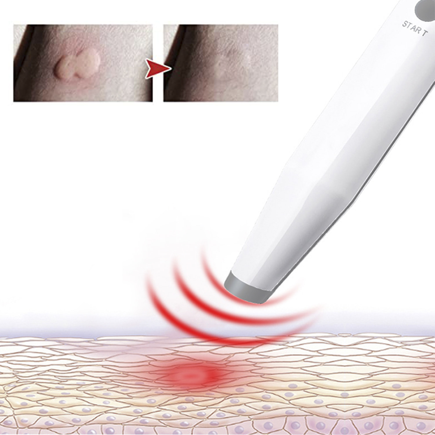 Sollievo da punture e morsi di insetti. Strumento elettronico per alleviare le punture di cimici e zanzare.