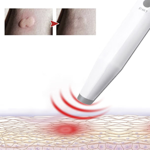 Sollievo da punture e morsi di insetti. Strumento elettronico per alleviare le punture di cimici e zanzare.
