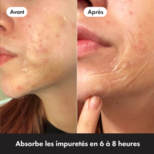 HERO Mighty Patch - Patchs Anti-Acné Surface 10 Patchs