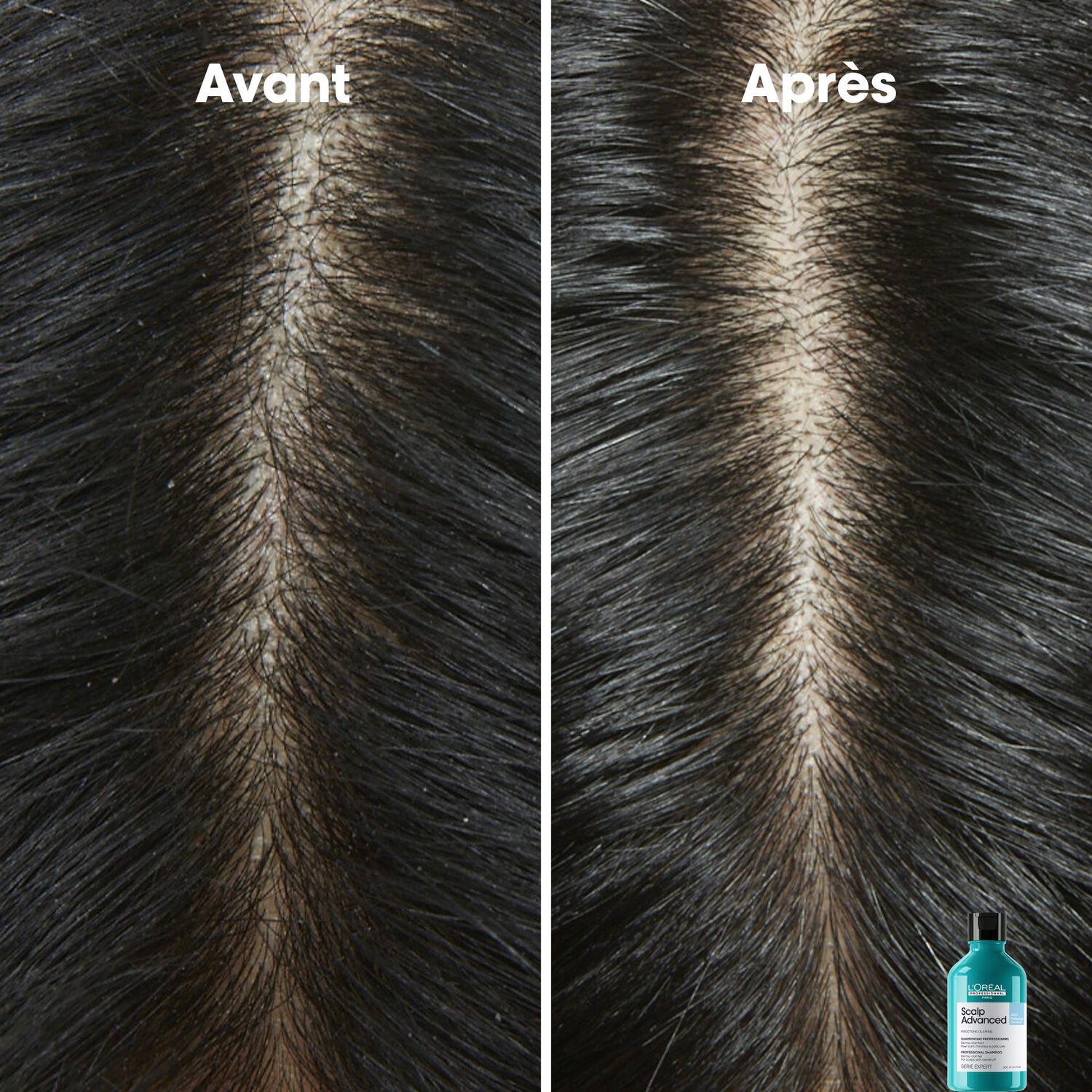 Scalp Advanced - Shampooing Dermo-Clarifiant - Cuirs Chevelus à Pellicules 300 ml