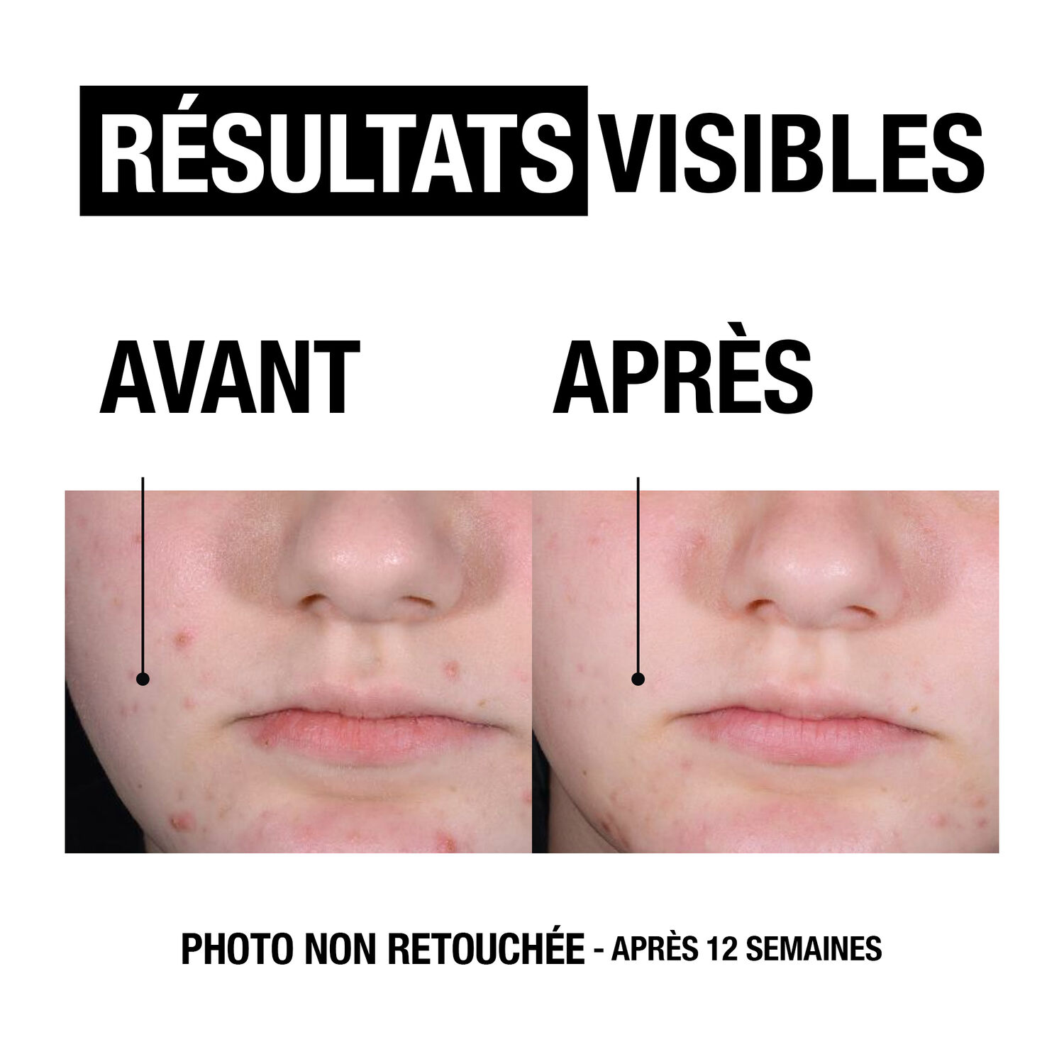 Anti-Boutons+ - Exfoliant Liquide - Sans Parfum - 125 ml