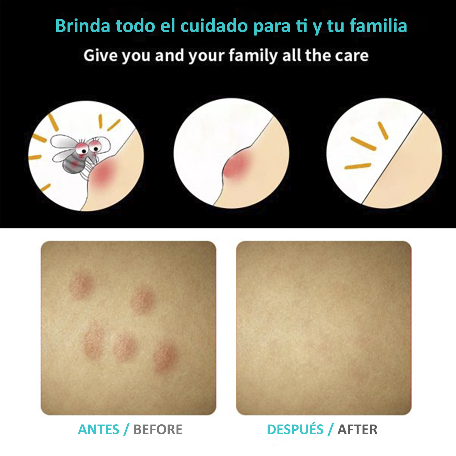 Alivio de picaduras y mordeduras de insectos. Tratamiento sin productos químicos de las picaduras y mordeduras.