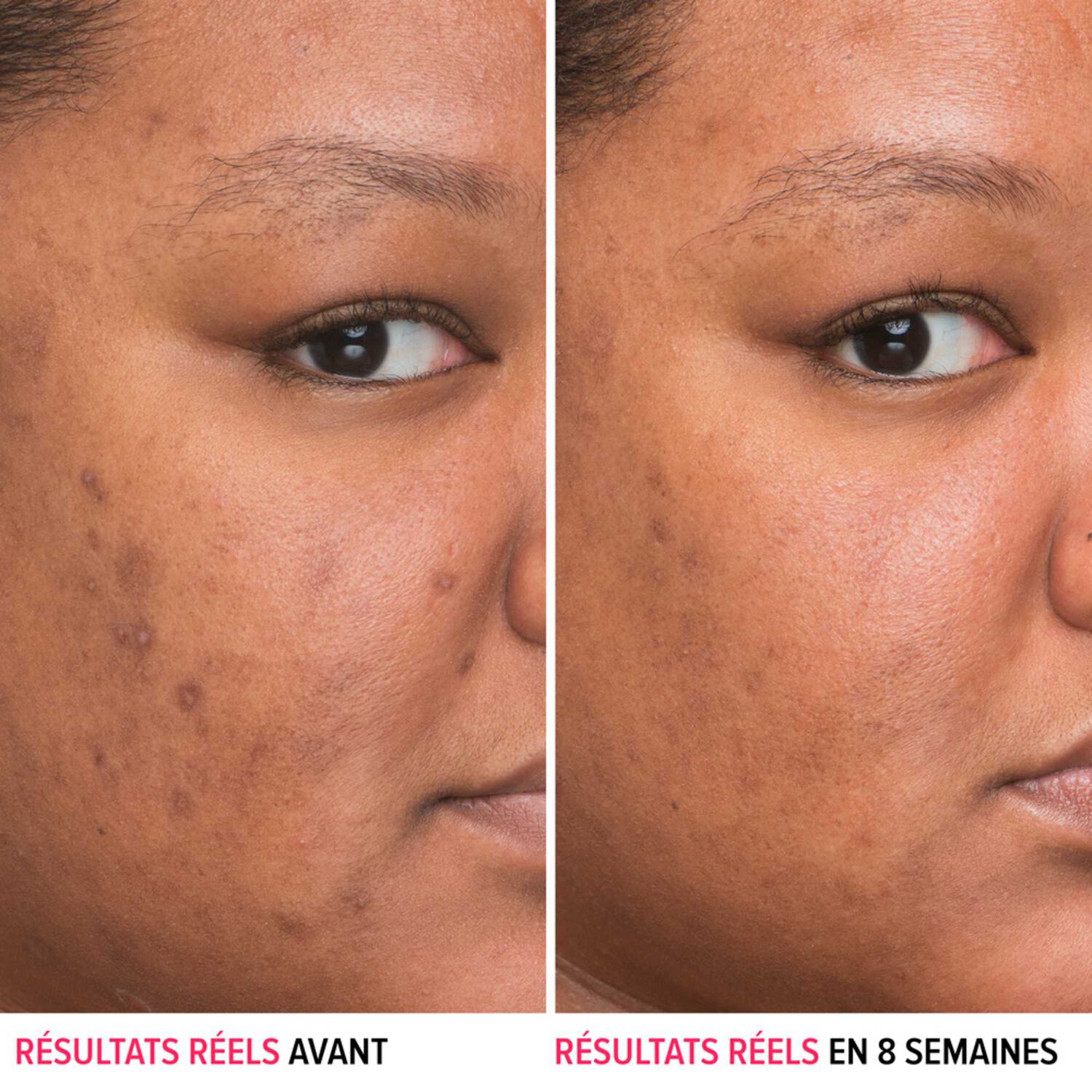 Bye Bye Darkspots - Sérum Anti-Tâches au Niacinamide 30 ml